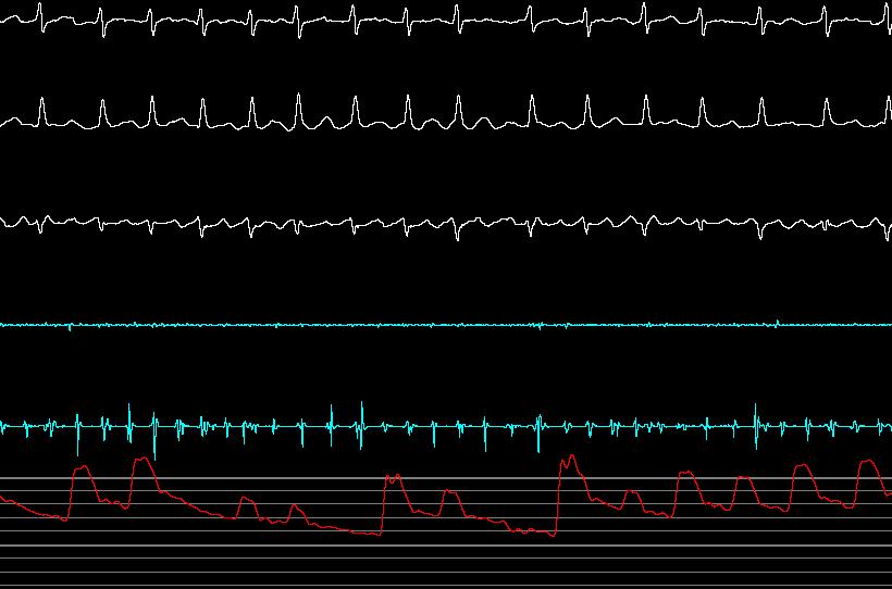 Pulsitility and R-R CS intervals d Femoral Art.