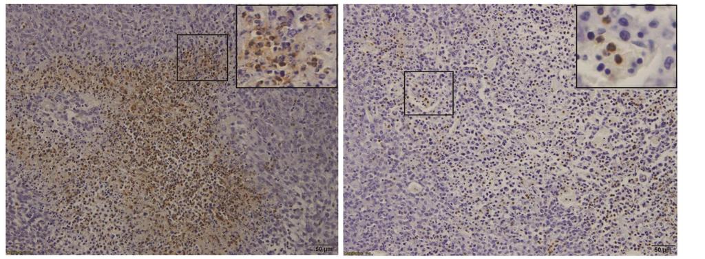 IL-17 controls neutrophil recruitment in tumor microenviroment