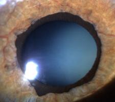 Glaucoma agudo ângulo fechado. Neurosifílis.