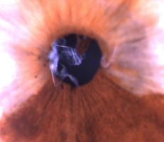 2 Resquícios da membrana pupilar Membrana pupilar persistente Consiste na
