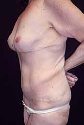 Abdominoplastia