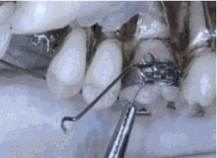 a movimentação do dente. (GANDINI JUNIOR et al., 2009).