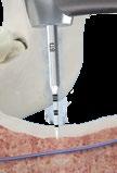Inserção do implante no alvéolo gerado, com apoio na