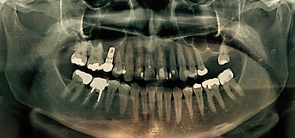 No préoperatório foi administrado à paciente Dexametasona 4 mg e amoxicilina 1 grama uma hora antes do procedimento.