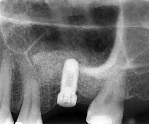 8 - Instalação do implante.