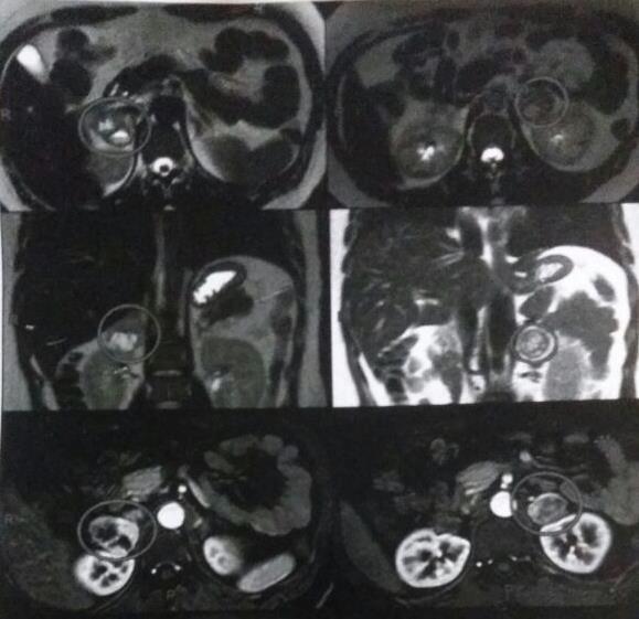 Figura 1. Imagens de ressonância magnética do abdome evidenciando lesões adrenais à esquerda e à direita (destacadas com círculos).