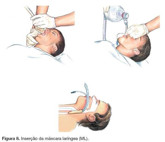 12 a 15 ciclos/min Inserir cânula de