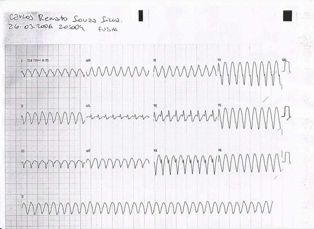 zero, não há pulso, nem batimento cardíaco = PARADA CARDÍACA No ECG temos