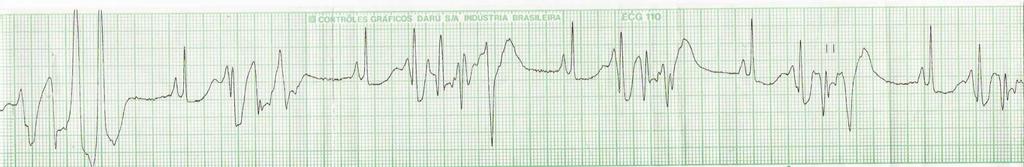 Quando presentes não tem relação com o QRS QRS: