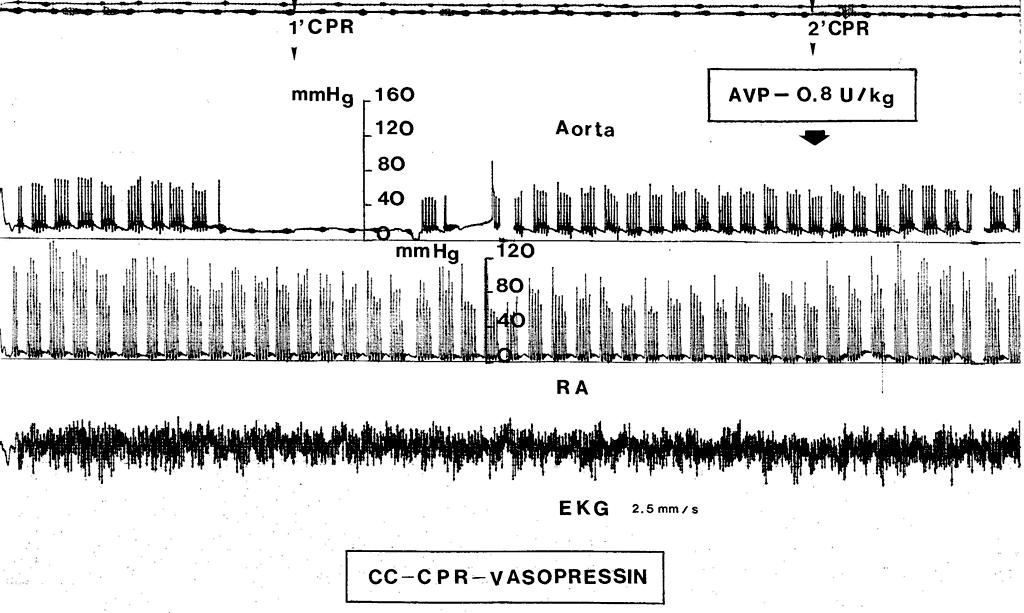 Compressão Torácica Externa Fazer pausa para ventilação após a 30 a compressão com 1 ou 2 reanimadores Pico de