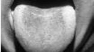 Fase sintomática inicial Leucoplasia Pilosa Oral Gengivite Úlceras Aftosas