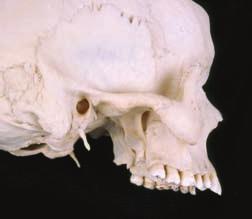 l A membrana fibrosa da cápsula articular que envolve a articulação temporomandibular fixa-se ao redor da área articular do osso temporal e do colo da mandíbula.