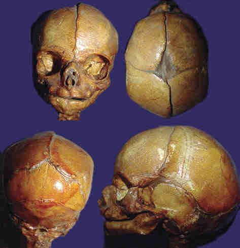 60 Neuroanatomia Clínica e Funcional: Anatomia, Fisiologia e Patologia É pelo forâmen carotídeo externo que a artéria carótida interna penetra no crânio.