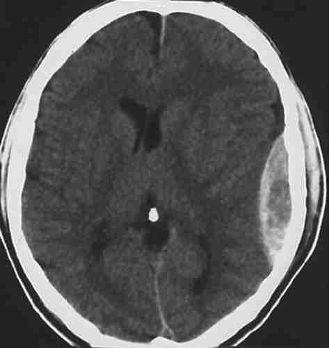 próprio osso temporal, identificado na face interna da base craniana. É pelo forâmen carotídeo interno que a artéria carótida interna penetra no seio cavernoso.