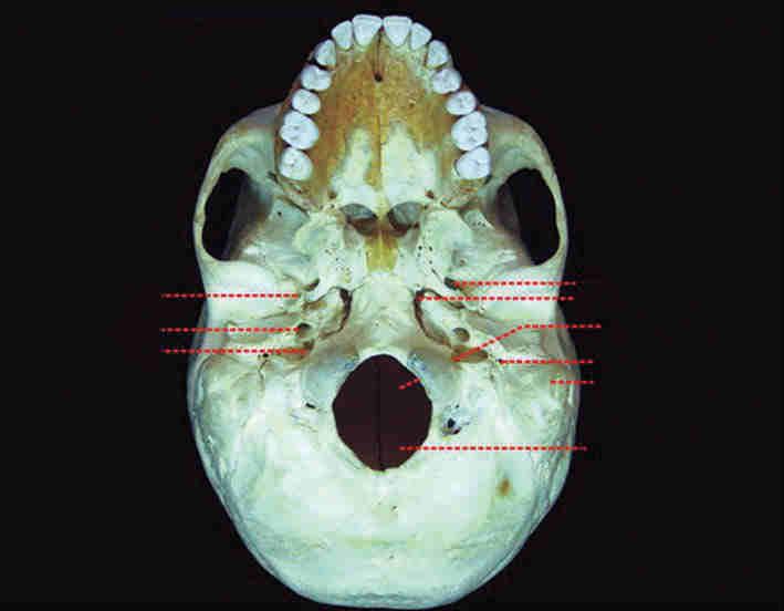 3 Crânio 59 O limite posterior da sela turca se faz com o clivo do esfenoide, no limite entre a fossa média e a fossa posterior, anteriormente ao tronco encefálico.
