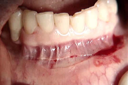 44 Figura 3 Incisão em