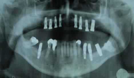 instalados 08 implantes (SIN) para