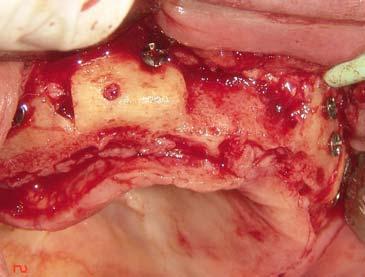 Figura 10 Instalação dos implantes