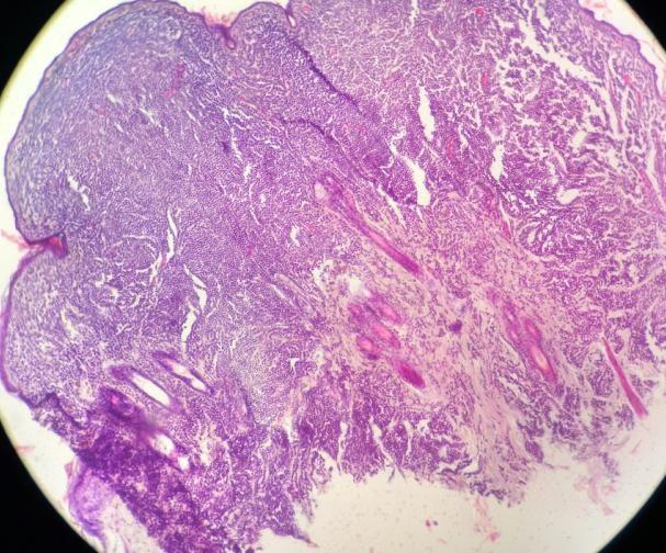Fonte: Amanda dos Santos Vitória Figura 2 Aspecto histológico do mastocitoma felino bem diferenciado.