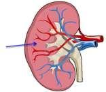 Lesão Renal Aguda Renal Necrose Tubular Aguda (NTA) Isquemia (50%) Hipotensão Choque hipovolêmico Sepse Choque cardiogênico Após PCR Nefrotoxicidade de drogas (35%) (toxinas endógenas e exógenas)