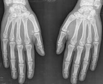 ANA RITA CRAVO E COL. Figura 7 (Caso clínico 2). Radiografia das mãos AP Figura 9 (Caso clínico 2). Radiografia dos joelhos AP Figura 8 (Caso clínico 2).