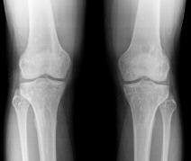 2,3 Radiologicamente, são características as lesões escleróticas, ovaladas ou arredondadas com 2 a 10 mm de diâmetro, nas zonas justa-articulares dos ossos do carpo, metáfises e