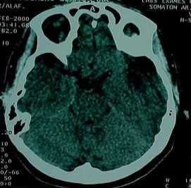 Hipertensiva Hemorragia intracraniana