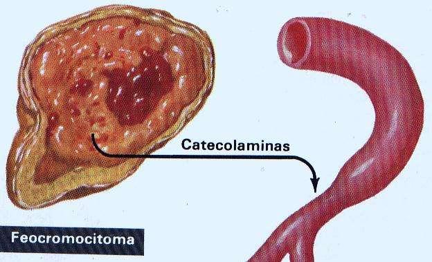 EMERGÊNCIAS POR EXCESSO DE CATECOLAMINAS FEOCROMOCITOMA Fentolanina 5-15 mg IV controle paroxísmos INGESTÃO DE COCAÍNA/OUTROS