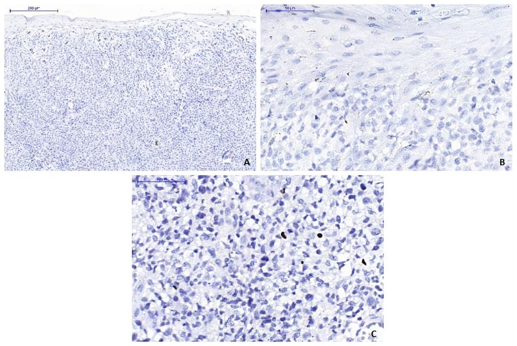 Figura 9 Micose fungoide em fase tumoral; A)Infiltrado linfocitário atípico estendendo-se à derme reticular e ausência da expressão do FOXP3 (escore 0).