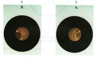 Desde que foi possível observar a membrana do tímpano, reconheceu-se que a imagem otoscópica apresentava variação com a idade e com o tipo e intensidade da luz utilizada 1 (Figura 1).
