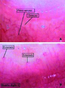 DANIELA G PETRY E COL. Figura 3. Capilares em «arbustos», sugestivos de dermatomiosite. Figura 2. Capilaroscopia periungueal mostrando padrão esclerodérmico com deleção (A) e ectasia capilares (B).