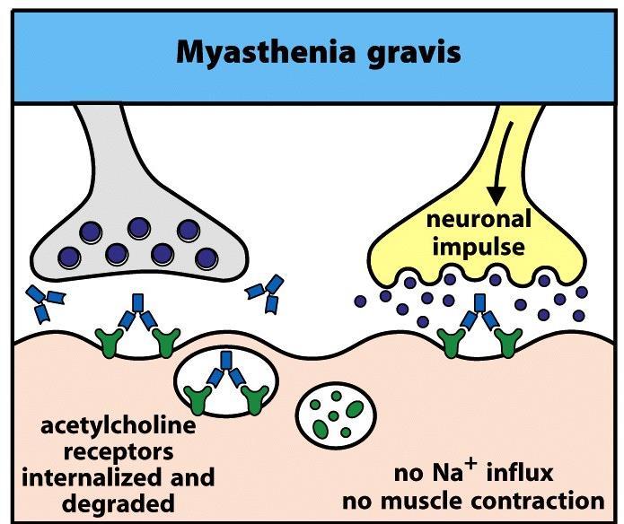 neuromusculares Mecanismo da doença: Anticorpos bloqueiam o receptor de