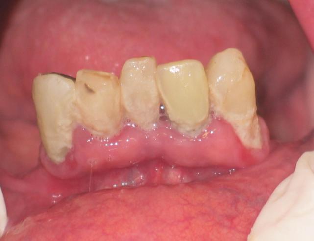 2 - Lesão hiperplásica inflamatória em lábio superior decorrente de prótese mal adaptada em paciente com