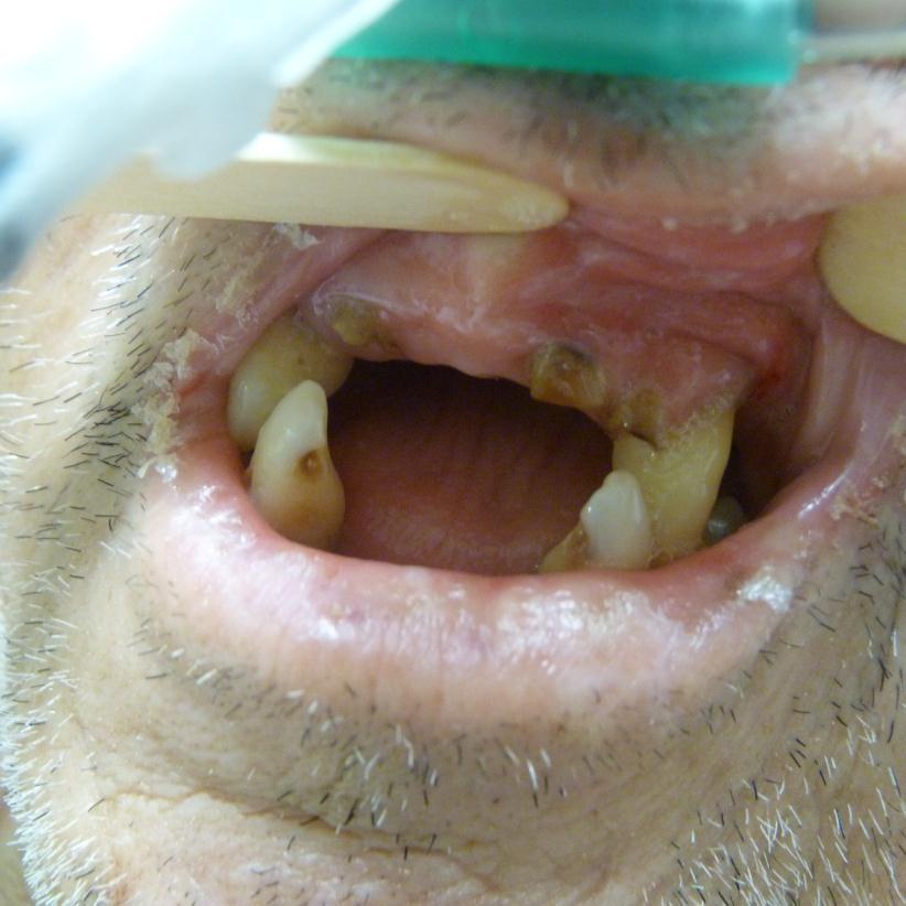 87 Discussão Foto 5- Condição bucal de um dos participantes da pesquisa.