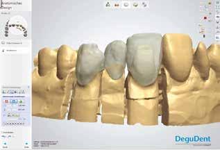 Esta coroa / ponte é injetado usando uma das pastilhas de dentina (LT) e Celtra Ceram é então usado para completar a anatomia.