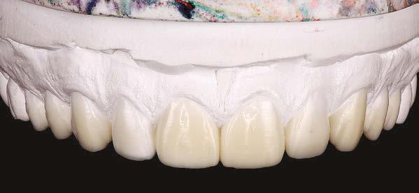 30 Restaurações cerâmicas em dentes anteriores: