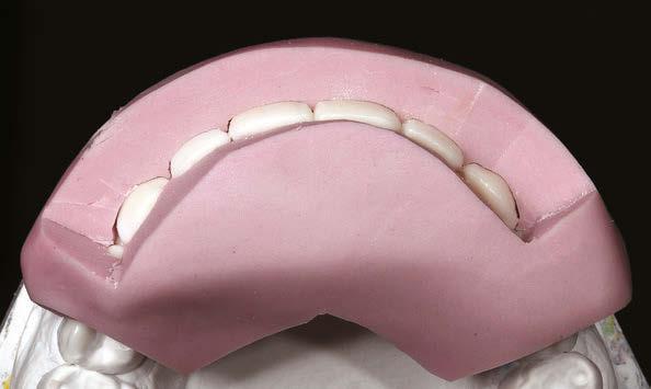 22 Restaurações cerâmicas em dentes anteriores: preparos e provisórios 16 16, 17, 18.
