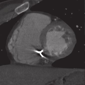 finais de 190 ml e 267 ml, respectivamente. O VE apresentou-se com função normal. Figura 3. Tomografia cardíaca demonstração da função do VD, mostrando as fases diastólica (A) e sistólica (B) finais.
