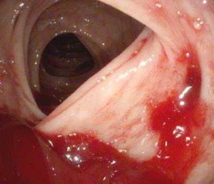 DOENÇA DIVERTICULAR DO COLON Projeções saculares, > assintomáticas Altas pressões colônicas Fatores de risco: idade, dieta pobre em fibras, constipação, sedentarismo, AAS Sangramento em divertículo