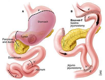 TRATAMENTO CIRÚRGICO DA ÚLCERA GÁSTRICA ÚLCERAS TIPOS II E III (são hiperclorídricas) Vagotomia troncular mais antrectomia ÚLCERA TIPO I (hipoclorídrica) ÚLCERA TIPO IV