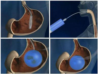 BALÃO INTRAGÁSTRICO (não cirúrgico) Terapia auxiliar