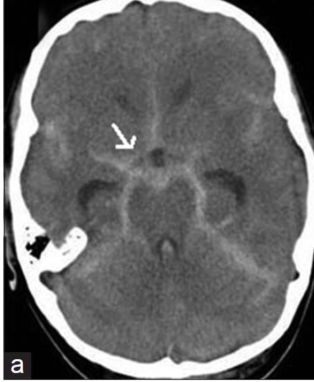 complicações; Terapêutica especifica de acordo com etiologia TERAPEUTICA CIRUGICA drenagem de hematoma,