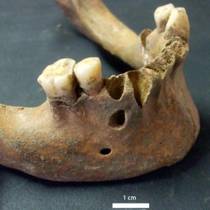 Patologias Nesta amostra foram observados dois casos de doença periodontal (Tabela 22) ambos na mandíbula e em indivíduos do sexo masculino.