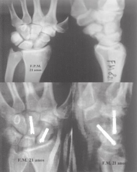 Síndrome escafocapitato 435 Figura 3 aso 2: FPM, 21 anos. e ) Radiografias em P e perfil pré-operatórias acima; e ) Radiografias em P e perfil no período pós-operatório imediato.