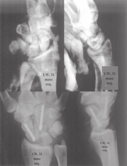 e ) Radiografias em P e perfil pré-operatórias acima; e ) Radiografias pós-operatórias abaixo. fulcro contra a borda dorsal do rádio distal (12-14).