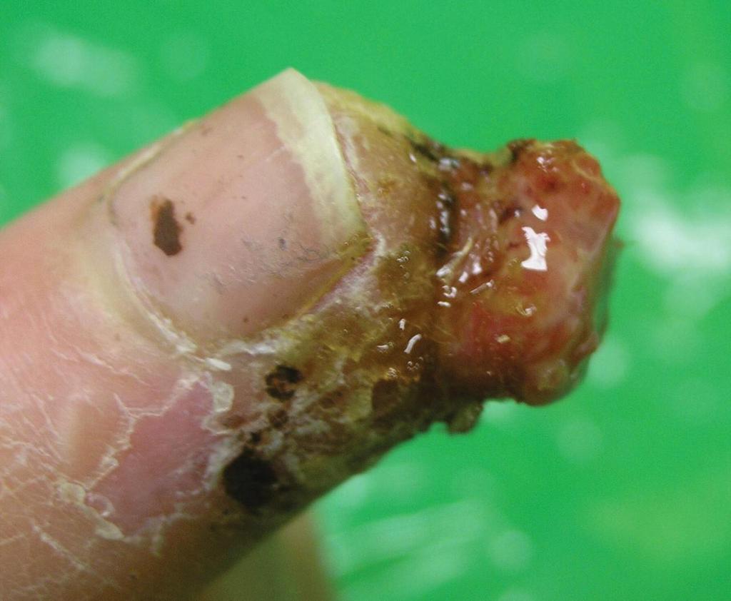 Lesão verrucosa de tuberculose cutânea no polegar de um veterinário (M. bovis) Twomey D F et al.