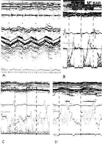 430 arquivos brasileiros de cardiologia Fig. 1 - Ecocardiograma modo M e eco-doppler do caso 1 - A - modo M mostrando a cinética normal do disco da prótese e posição mitral.