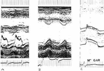 ecocardiografia doppler 431 A aortografia confirmou regurgitação muito importante e, na cirurgia, encontrou-se desinserção na parte ânterodireita da prótese valvular.