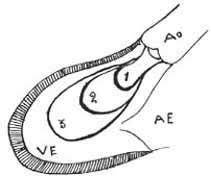 3 - Eco-Doppler do caso 2. A - demonstração de turbulência na região subaórtica, devida à insuficiência aórtica. B - vizibilização de turbulência da via de saída do ventrículo esquerdo.