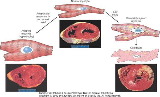 Alterações no Miocárdio 10 Hipertrofia Cardíaca 11 Hiperplasia Aumento da quantidade (número) de células aumento da massa de